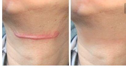 逆襲一切眼袋，北京空軍總醫(yī)院祛除效果如何？祛除價格詳解！