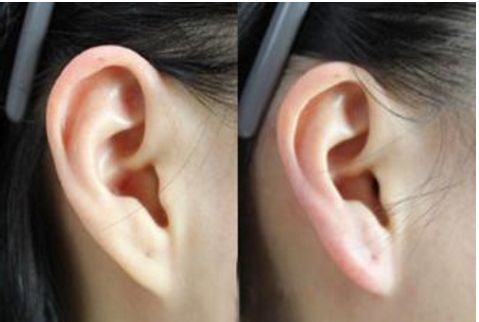 吳焱秋雙眼皮修復(fù)經(jīng)驗(yàn)分享，完美修復(fù)雙眼皮毀容案例分析