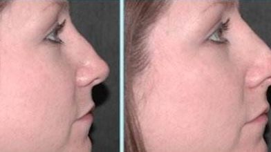 2023年中山市自體脂肪注射醫(yī)生排行榜公布，權(quán)威專家名單羅興源、李光琴、周旭剛等入選