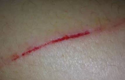 徐曉斐深度解析眼角修復(fù)技巧，專(zhuān)業(yè)推薦!大家點(diǎn)贊!