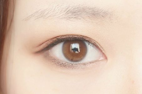 青島安娜整形醫(yī)院面部填充效果如何？真實(shí)案例告訴你！