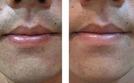 杭州銅雀臺美容整形醫(yī)院：嶄新隆胸案例分享及顧客評價揭秘