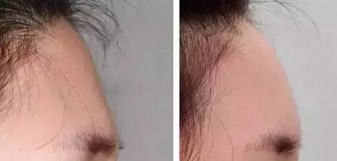 哈爾濱伊美爾醫(yī)療美容醫(yī)院，專家醫(yī)師解析與隆鼻案例分析