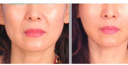 西安國際醫(yī)學(xué)整形醫(yī)院孫峰醫(yī)生的雙眼皮修復(fù)案例分享！