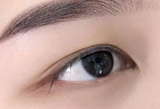 淮安華美整形：程宏宇醫(yī)生獨(dú)特技術(shù)修復(fù)雙眼皮，專屬案例分享！