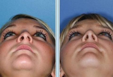 武漢美立方胡江偉醫(yī)生詳細(xì)介紹及最新價(jià)格公開(kāi)！附帶雙眼皮案例及2023費(fèi)用參考