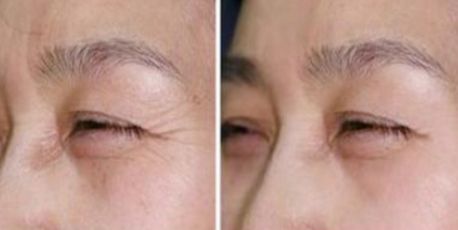 謝福庚雙眼皮手術(shù)技術(shù)及口碑評(píng)價(jià)，新上線專(zhuān)家報(bào)道