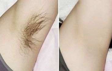 陳文莉天津雙眼皮手術(shù)效果怎么樣？獨(dú)特經(jīng)歷揭示