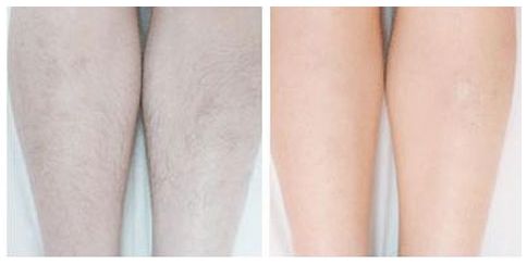 梁耀嬋豐胸術(shù)：專家經(jīng)驗解析，全方位分享自體脂肪豐胸案例