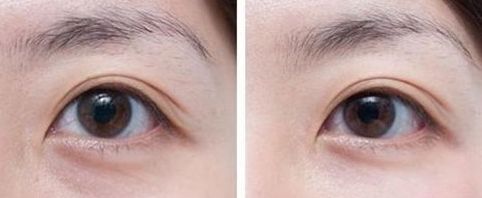 國內(nèi)熱門雙眼皮手術(shù)專家排行榜，揭曉醫(yī)生絕技