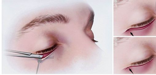 常冬青醫(yī)生的神奇術(shù)式：讓眼袋煩惱遠(yuǎn)離你！