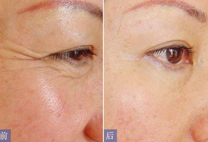 普洱市人民醫(yī)院整形科的專家介紹及隆胸案例分享