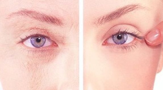 武漢美基元項(xiàng)利姣：祛眼袋30天回復(fù)細(xì)節(jié)圖大曝光！