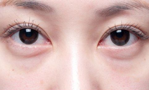 宋國棟雙眼皮恢復(fù)案例令人驚嘆！80天見證奇跡