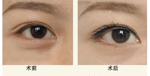 上海千美整形醫(yī)院吸脂術(shù)的效果及革新案例展示