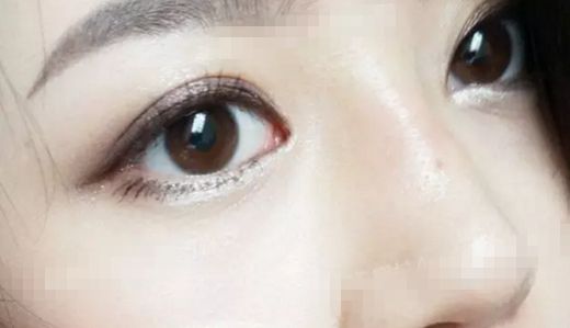 王金明雙眼修復情況如何？醫(yī)生經驗+雙眼整形案例。