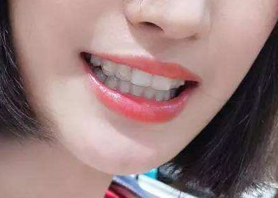 鄭東醫(yī)生鼻子整形成果揭秘！目擊案例揭示真實效果！