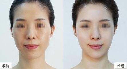 探秘歐洲之星FOTONA4D，速效消除頸紋，讓你告別滄桑紋