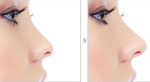 長春市哪家醫(yī)院的抽脂減肥效果較好，推薦一些知名機(jī)構(gòu)