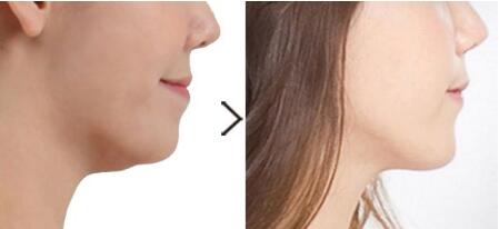 明星都是怎么做到牙齒美白的？常見牙齒美白方式有哪些值得推薦？