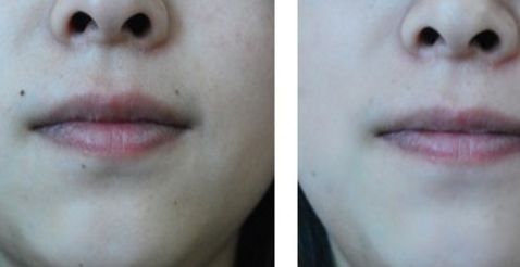 除皺針福州哪家醫(yī)院好？選擇時(shí)需考慮醫(yī)院的專(zhuān)業(yè)團(tuán)隊(duì)與豐富經(jīng)驗(yàn)