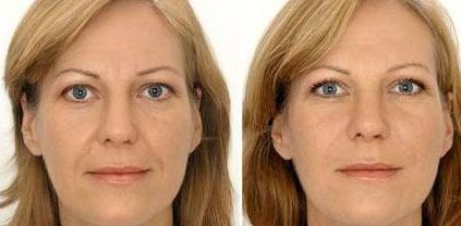 成都眼紋微整形口碑醫(yī)院榜單：實(shí)力PK，助你重塑年輕之眸