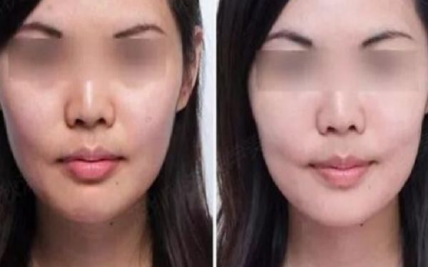 紹興哪家醫(yī)院填充鼻唇溝效果好？排名前10值得信賴的醫(yī)院推薦