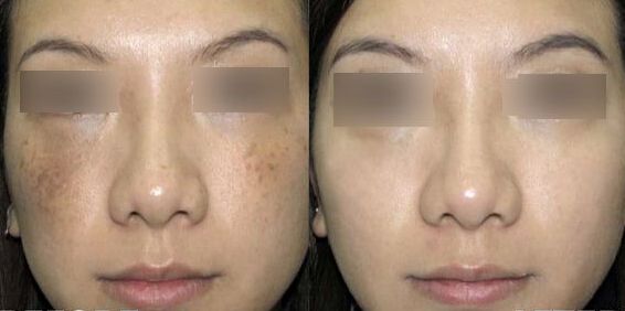 沈陽眼角紋消除好口碑醫(yī)院推薦精選