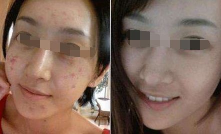 重慶實力拔群：點陣激光祛痘口碑前10家整形美容醫(yī)院盤點