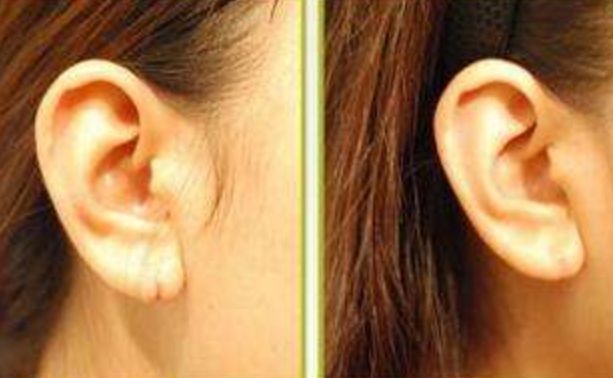 自體脂肪豐胸需要注意的風(fēng)險(xiǎn)與注意事項(xiàng)