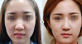 成都有哪些專業(yè)瘦后背醫(yī)院？