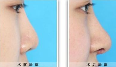 西安哪家醫(yī)院做脂肪豐胸效果好，排名榜前幾？