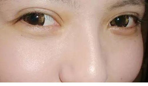 上海哪家醫(yī)院的面部抽脂效果好