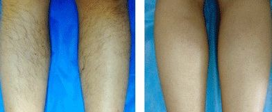 昆明哪家醫(yī)院治療疤痕效果好？專家推薦的昆明疤痕修復醫(yī)院有哪些？