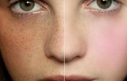 信陽拉觀眼皮哪家醫(yī)院好去哪家醫(yī)院拉觀眼皮效果好？