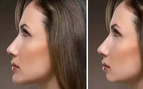 玻尿酸豐下巴效果如何？操作要注意的事項(xiàng)有哪些？