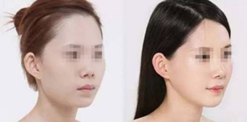 福州林潮鼻部整形評價和效果介紹