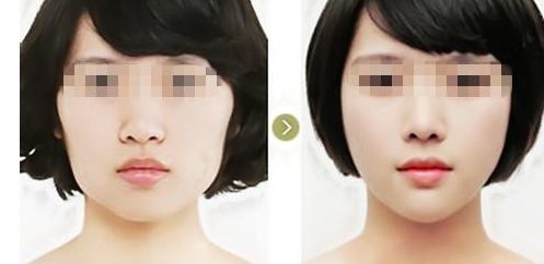 洛陽人氣度高的小切口祛眼袋醫(yī)院盤點