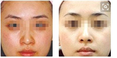 貴陽(yáng)美貝爾美容醫(yī)院推薦的鼻部整形專家