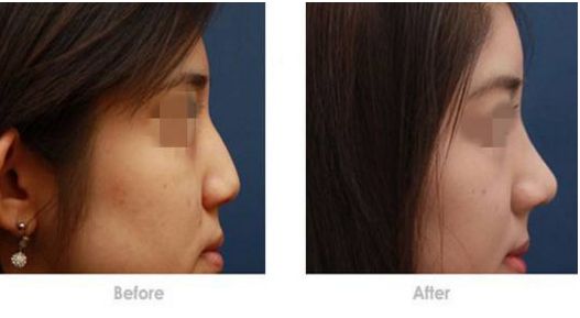 濟寧哪家醫(yī)院適合玻尿酸去黑眼圈？排名前10強美容機構(gòu)揭秘！