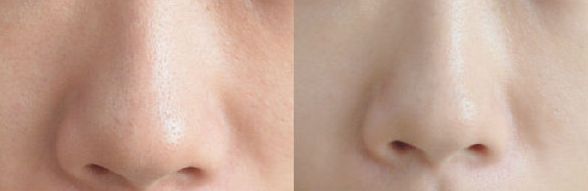 【2023最新】寧波治療痘印痘坑哪家好？專業(yè)醫(yī)師推薦