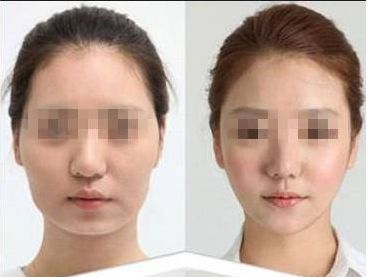 鹽城哪家醫(yī)院做玻尿酸淡化肥胖紋口碑好？推薦10家知名機(jī)構(gòu)