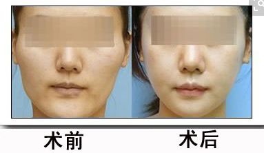 呼和浩特魚尾紋自體脂肪填充美容醫(yī)院口碑排名前10強，用戶口碑爆棚！