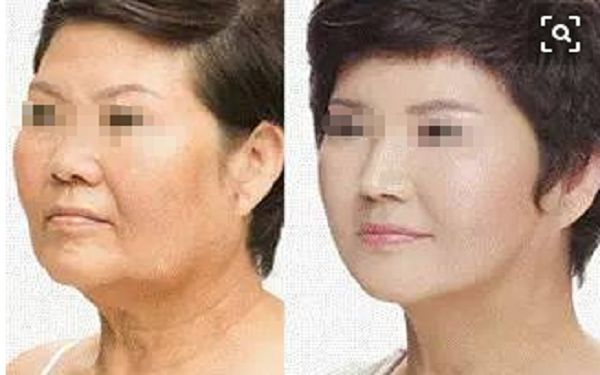 南寧哪家整形醫(yī)院效果好？唇紋祛除排名推薦！