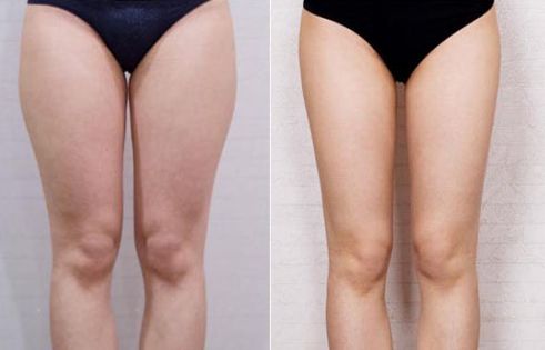 杭州哪家醫(yī)院治療疤痕效果好？推薦杭州修復(fù)疤痕的醫(yī)院專業(yè)醫(yī)美技術(shù)