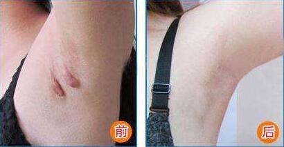 膠原蛋白豐唇是否安全有效？7大優(yōu)點(diǎn)你知道嗎？