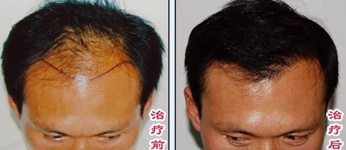 上海哪家醫(yī)院好專治曬斑的醫(yī)院推薦