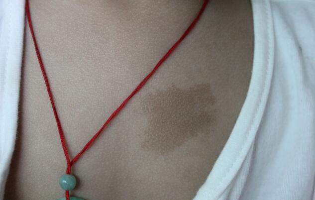 玻尿酸豐額頭為何造成凹凸不平？有效解決方法是什么？