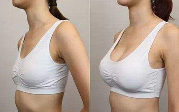 臀部抽脂需要多少錢，在哪里做最劃算？