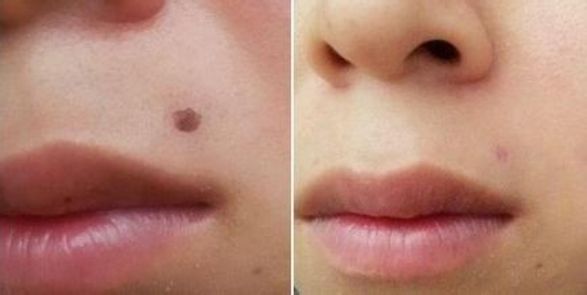 武漢哪家醫(yī)院專業(yè)從事線雕隆鼻手術(shù)效果好？